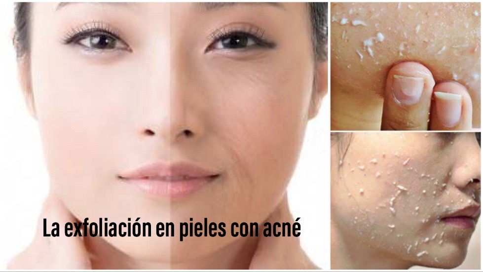 Exfoliación de la piel
